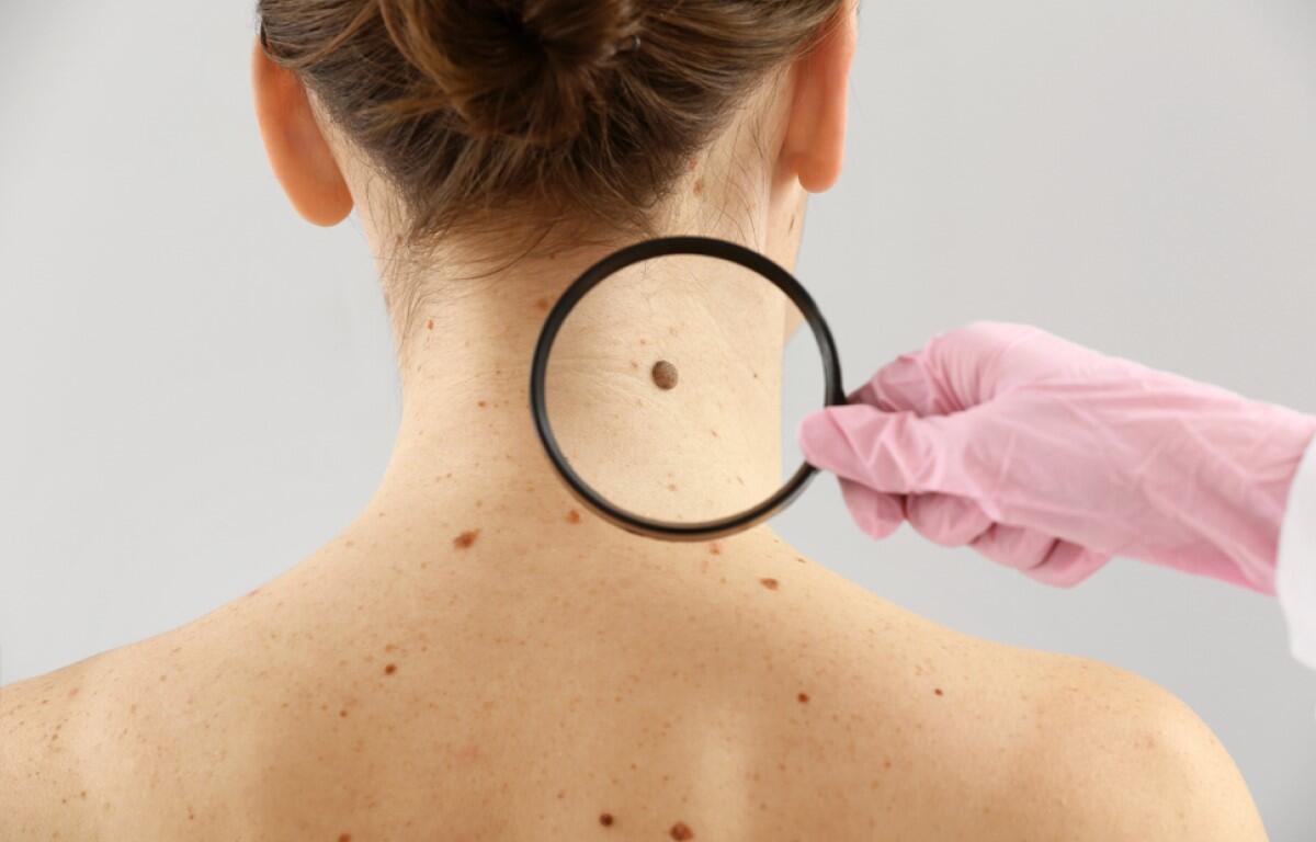 Skin cancer detection