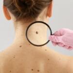 Skin cancer detection