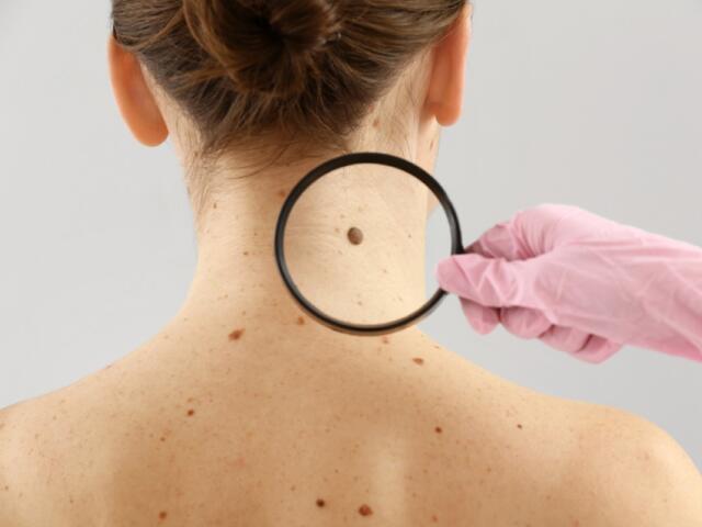 Skin cancer detection