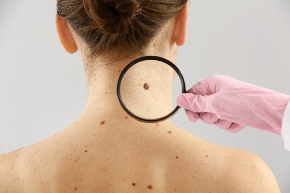 Skin cancer detection