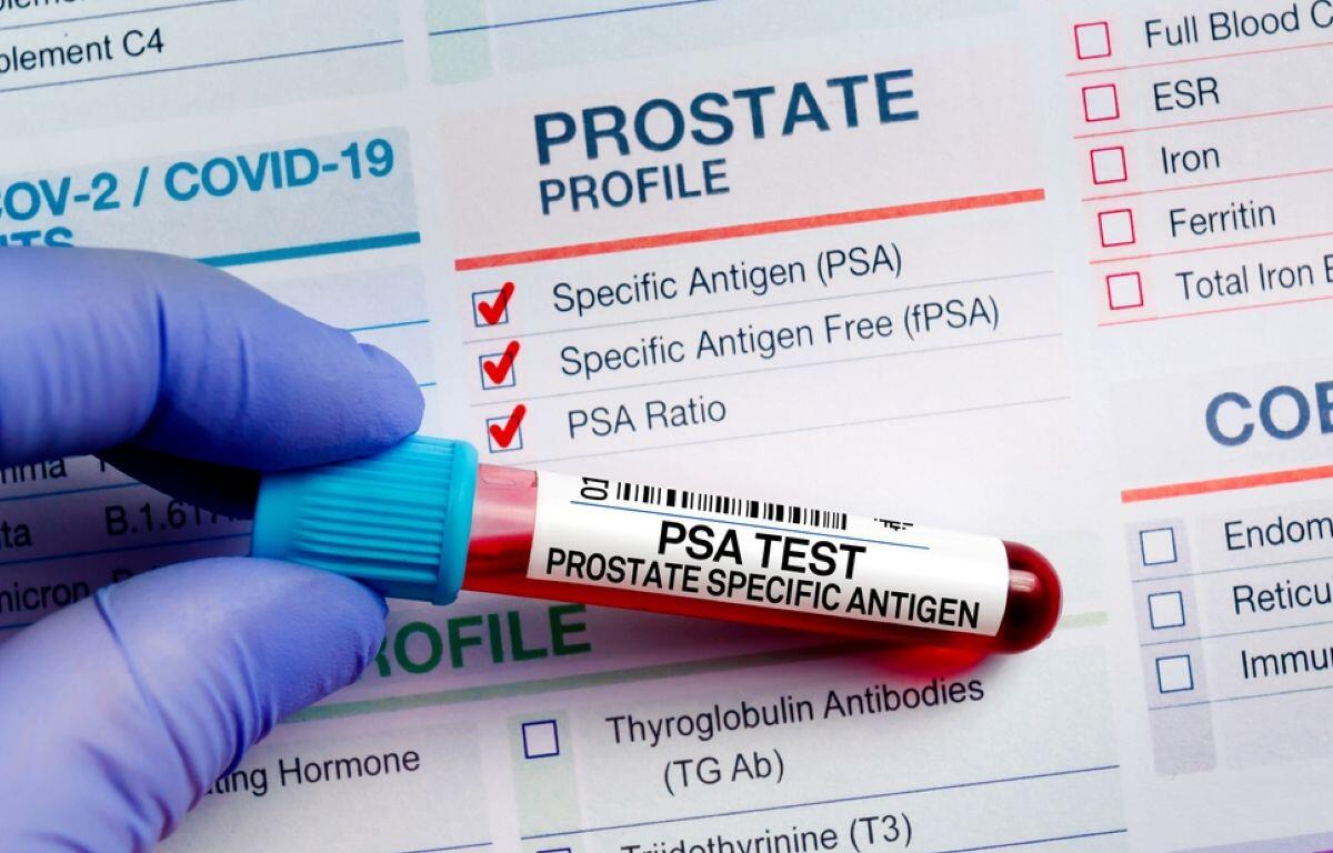 PSA test