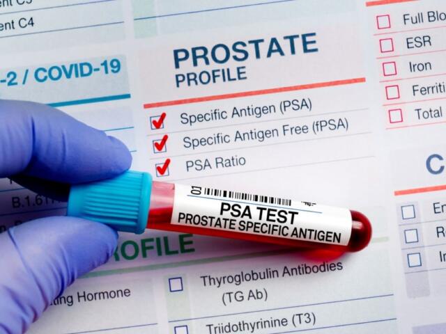 PSA test