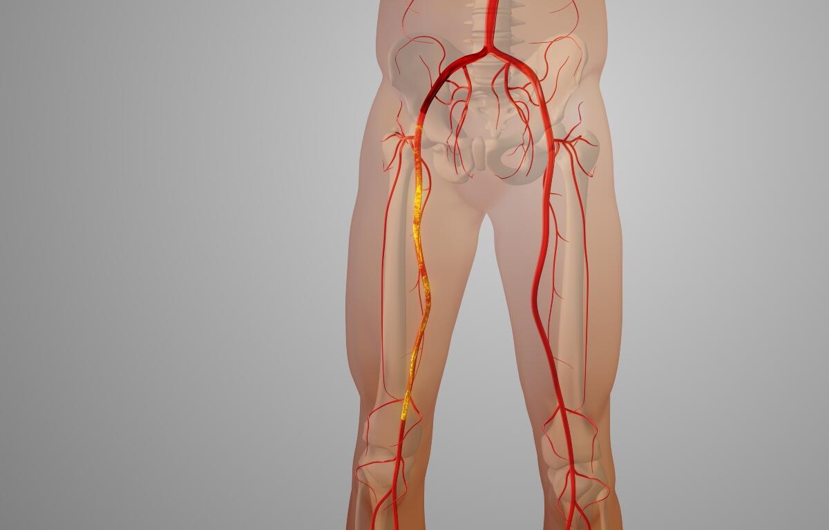 peripheral artery disease