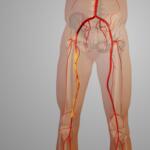 peripheral artery disease